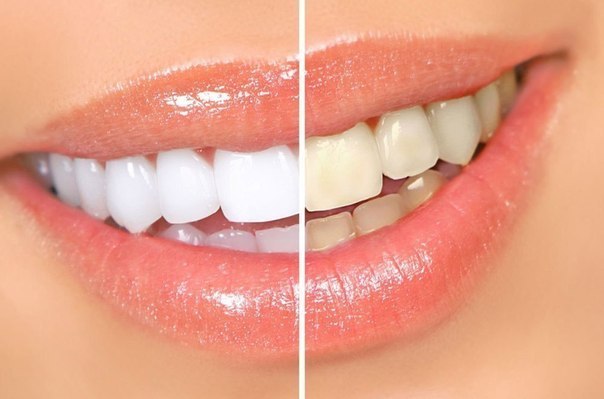 التخلص من إصفرار الأسنان بطرق طبيعية
