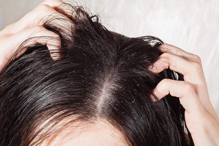 قشرة الشعر.. الأسباب والعلاج
