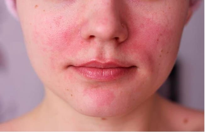 أهم طرق علاج اكزيما الوجه وكيفية الوقاية منها