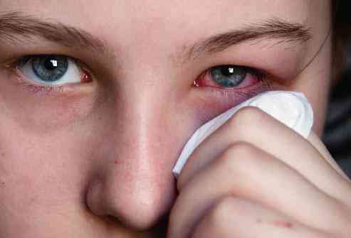طرق علاج حساسية العين وكيف يمكنك تجنب أعراضها
